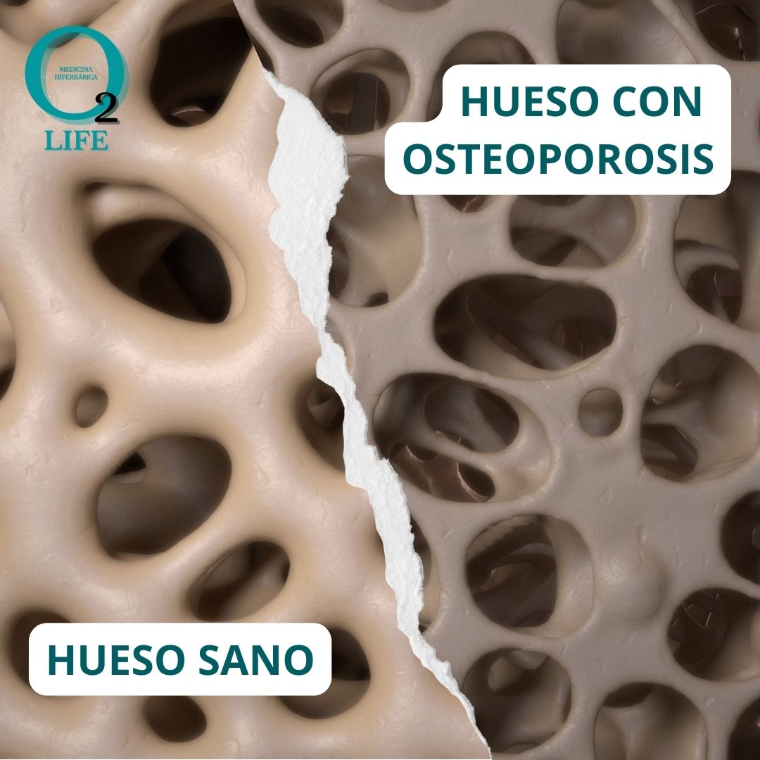 TRATAMIENTO DE LA OSTEOPOROSIS CON MEDICINA HIPERBÁRICA